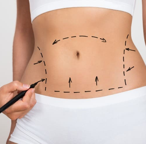 Abdominoplastia x Lipoaspiração: Entenda as Diferenças e Indicações