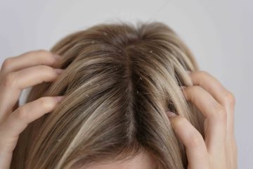 Dermatite seborreica – saiba como lidar com a condição