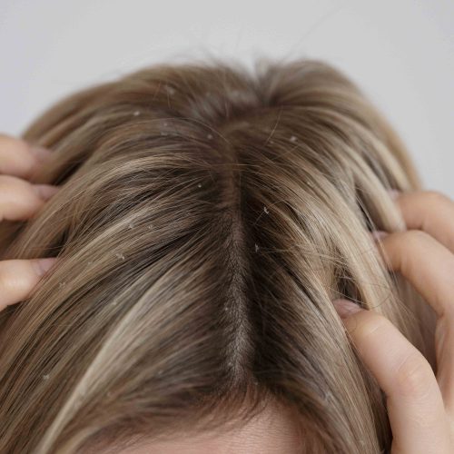 Dermatite seborreica – saiba como lidar com a condição