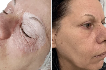 O poder transformador do peeling de ácido tricloroacético: uma investigação orbital