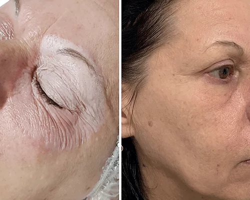 O poder transformador do peeling de ácido tricloroacético: uma investigação orbital