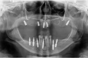O que o tempo faz com quem perde os dentes