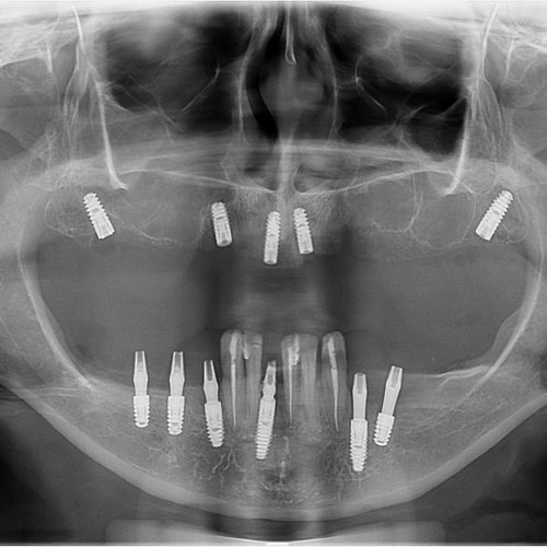 O que o tempo faz com quem perde os dentes